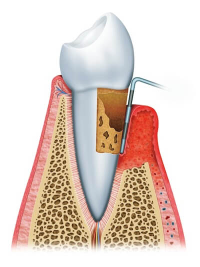 Gum disease illustration
