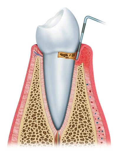 Gum disease illustration