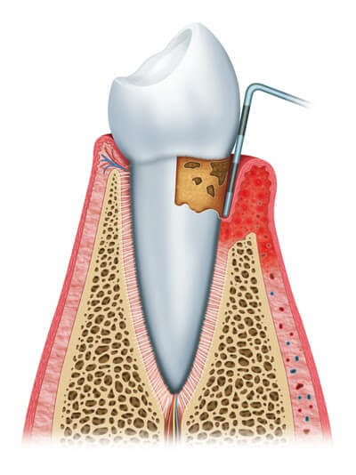 Gum disease illustration