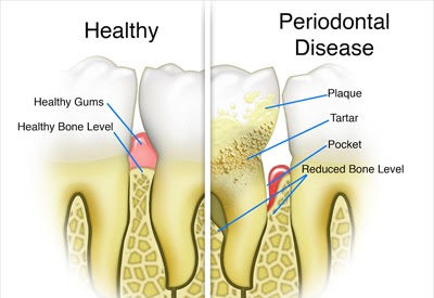 Periodontal disease infographic