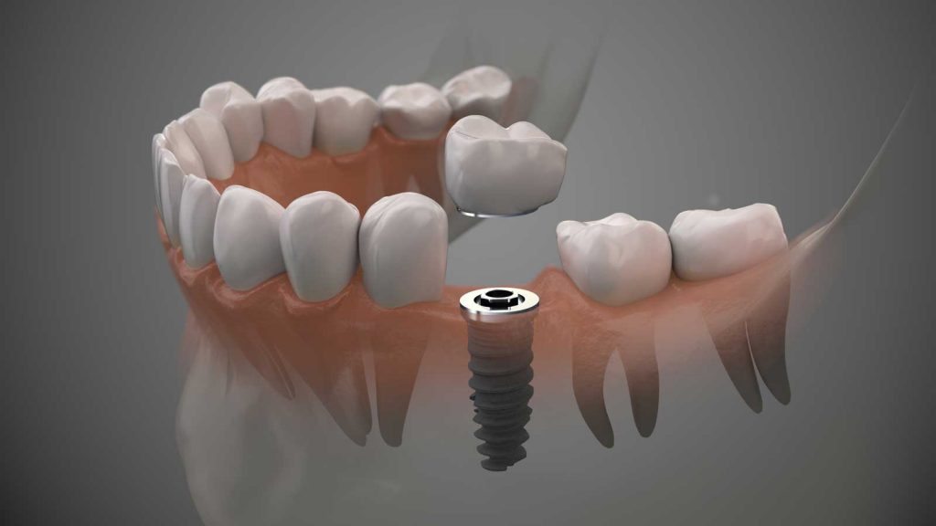 Illustration of a dental implant being placed