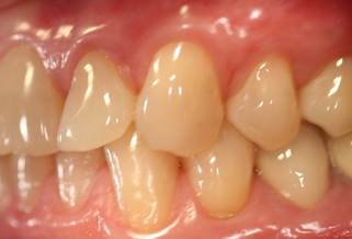 Patient's teeth before treatment