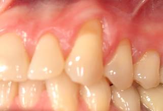 Patient's teeth before treatment