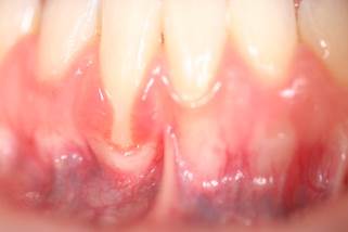 Patient's teeth before treatment