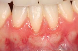 Patient's teeth before treatment